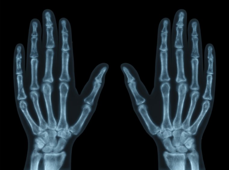 hand x ray clipart - photo #18